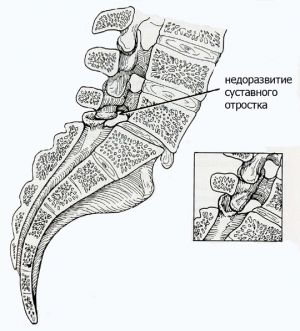 Рис.2. Схема диспластического  листеза. Антеролистез L5 позвонка.