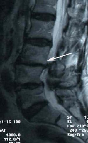 Рис.4. МРТ поясничного отдела позвоночника. Ретролистез L3  позвонка. Стрелкой указано  смещение L3 позвонка кзади.