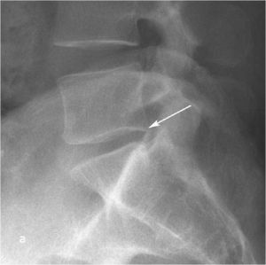 Рис. 8а. Рентгенограмма поясничного отдела позвоночника в боковой (а) и прямой (b) проекциях до операции. Стрелкой показано смещение тела L5 позвонка кзади. 