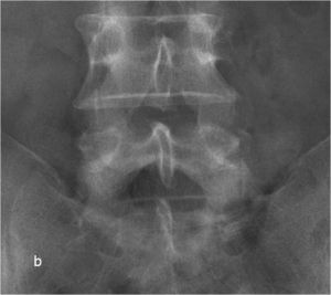 Рис. 8b. Рентгенограмма поясничного отдела позвоночника в боковой (а) и прямой (b) проекциях до операции. Стрелкой показано смещение тела L5 позвонка кзади. 