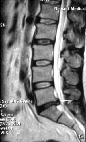 Рис. 9a. Магнитно-резонансная томография (МРТ) поясничного отдела позвоночника в сагиттальной (a) и аксиальной  (b) проекции. Стрелкой показана мп секвестрированная парамедианная грыжа диска L5-S1 слева. 