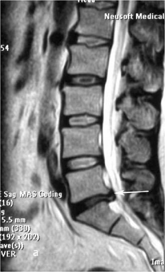 Протрузия диска на уровне l5 s1
