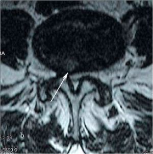 Рис.7b. Магнитно-резонансная томография (МРТ) поясничного отдела позвоночника в сагиттальной (a) и аксиальной (b) проекции. Стрелкой показана область стеноза позвоночного канала на уровне L4-L5 позвонков (7а) и м\п секвестрированная парамедианная грыжа диска L4-L5 слева на фоне стеноза позвоночного канала.