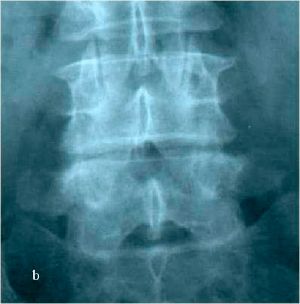 Рис. 8b. Рентгенограмма поясничного отдела позвоночника в боковой (а) и прямой (b) проекциях до операции. Стрелкой показано смещение тела L4 позвонка кпереди.