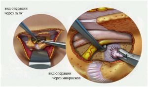 Рис.2. Разница в  способности увеличения изображения нервных структур хирургической лупы (слева) и хирургического микроскопа (справа).