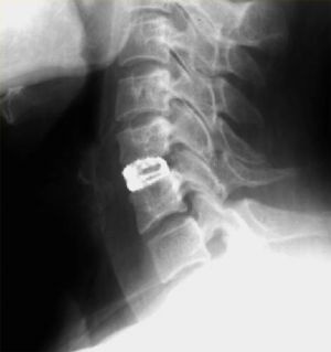 Рис. 4. Рентгенограмма шейного отдела позвоночника в боковой проекции. Имплантированный в межтеловое пространство С5-С6 кейдж, заполненный костной крошкой.