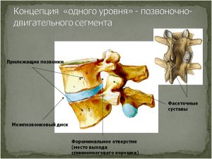 Парафораминальная грыжа диска