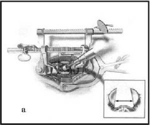 Рис.7а. Схема выполнения корпорэктомии (удаления части тела шейного позвонка) при помощи электрического бора (a) и результат выполненной корпорэктомии (b).