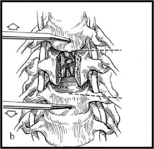  Рис.7 b. Схема выполнения корпорэктомии (удаления части тела шейного позвонка) при помощи электрического бора (a) и результат выполненной корпорэктомии (b).