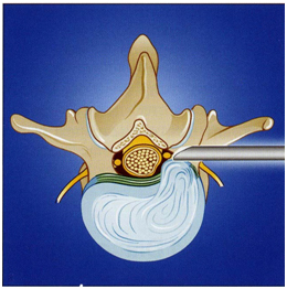 Рис.2. Схема трансфораминального  эндоскопического удаления грыжи диска  Рис.2. Схема трансфораминального  эндоскопического удаления грыжи диска