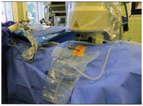 Рис.3.  Операция проводится под  контролем ЭОПа через прокол без разреза Рис.3.  Операция проводится под  контролем ЭОПа через прокол без разреза